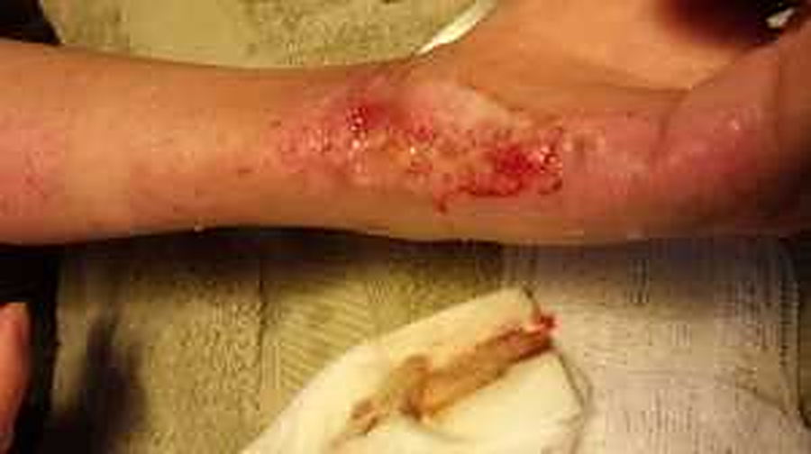 Nurse performing professional wound care at a client's home